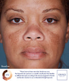Obagi Nu-Derm Trial Kit - Normal to Oily